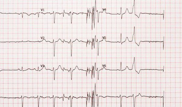 123-EKG-extrasystoles-09-18.jpg