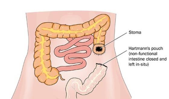 Stoma - Darm (Colostoma) | Gezondheid.Be