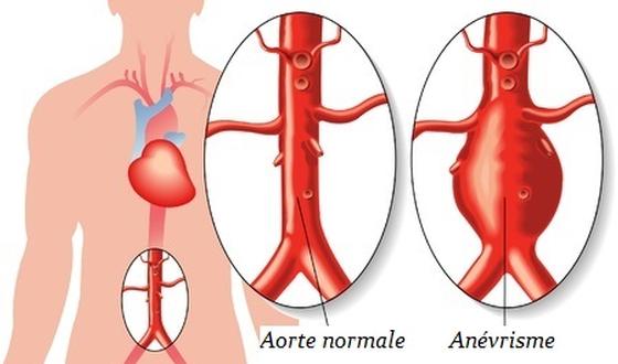 123-anévrisme-aorte-abdomen-9-8.jpg