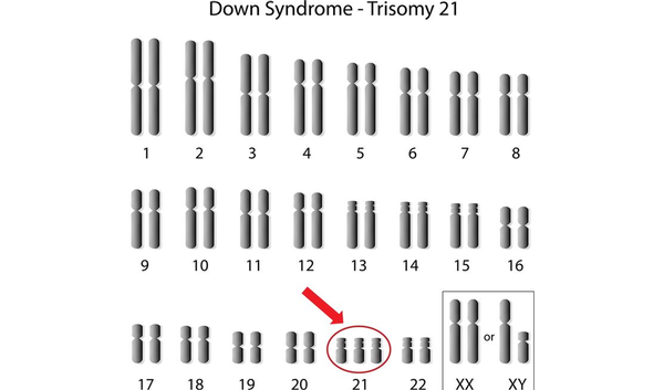 123-chromos-trisomy-21-karyotype-12-18.png