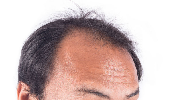 123-man-alopecia-kaalheid-10-18.png