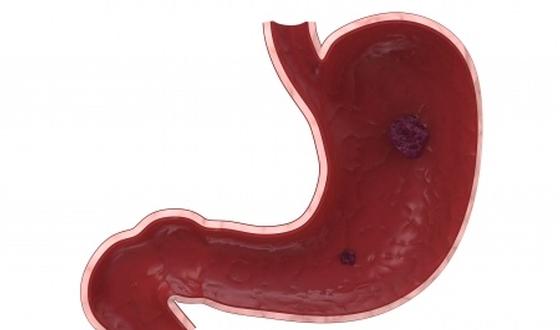 L'ulcère de l'estomac et du duodénum : causes, symptômes et ...