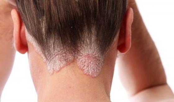 123-psoriasis-haarlijn-10-15.jpg