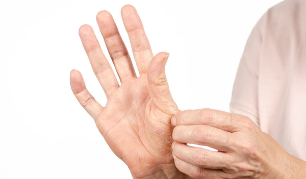 123-psoriasis-hand-04-19.png