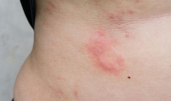Urticaire sur le ventre 123-urticaria-buik-10-17.jpg