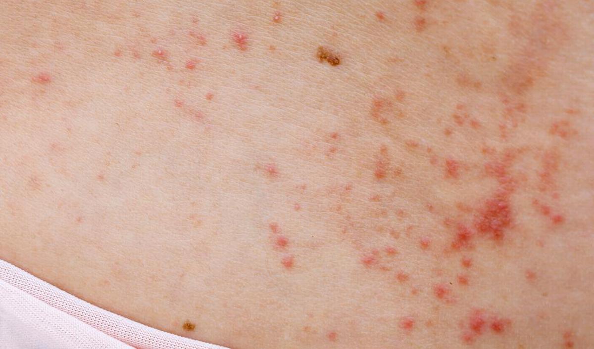 Rode Stippen Op Huiduitslag Hoe Ontstaat Zonneallergie Advies I Drs Rode Stippen Op Huiduitslag Hoe Ontstaat Zonneallergie Advies I Drs
