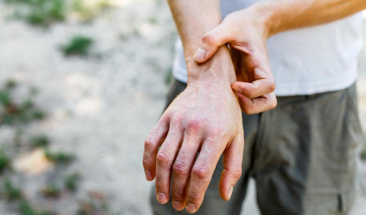 123_hand_huid_jeuk_eczeem.jpg