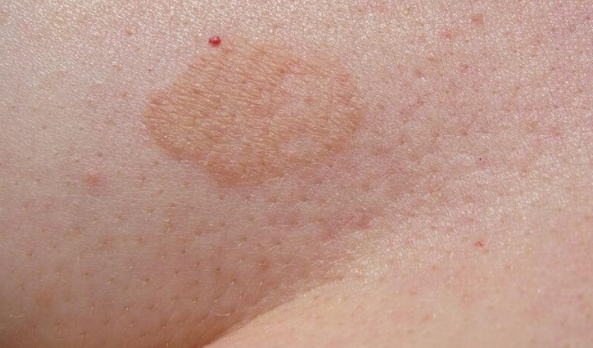 123_pityriasis_versicolor_2022.png