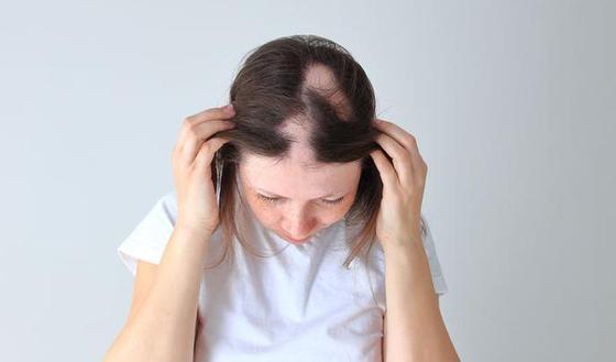 123m-alopecia-areata-haar-haren-17-2-21.jpg