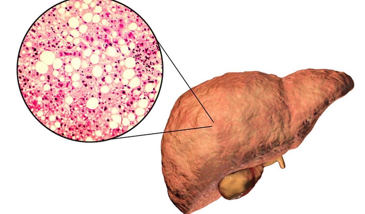 Getty_NASH_NAFLD_2024.jpg