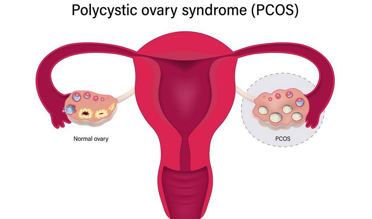 Getty_PCOS_eierstokken_2023.jpg