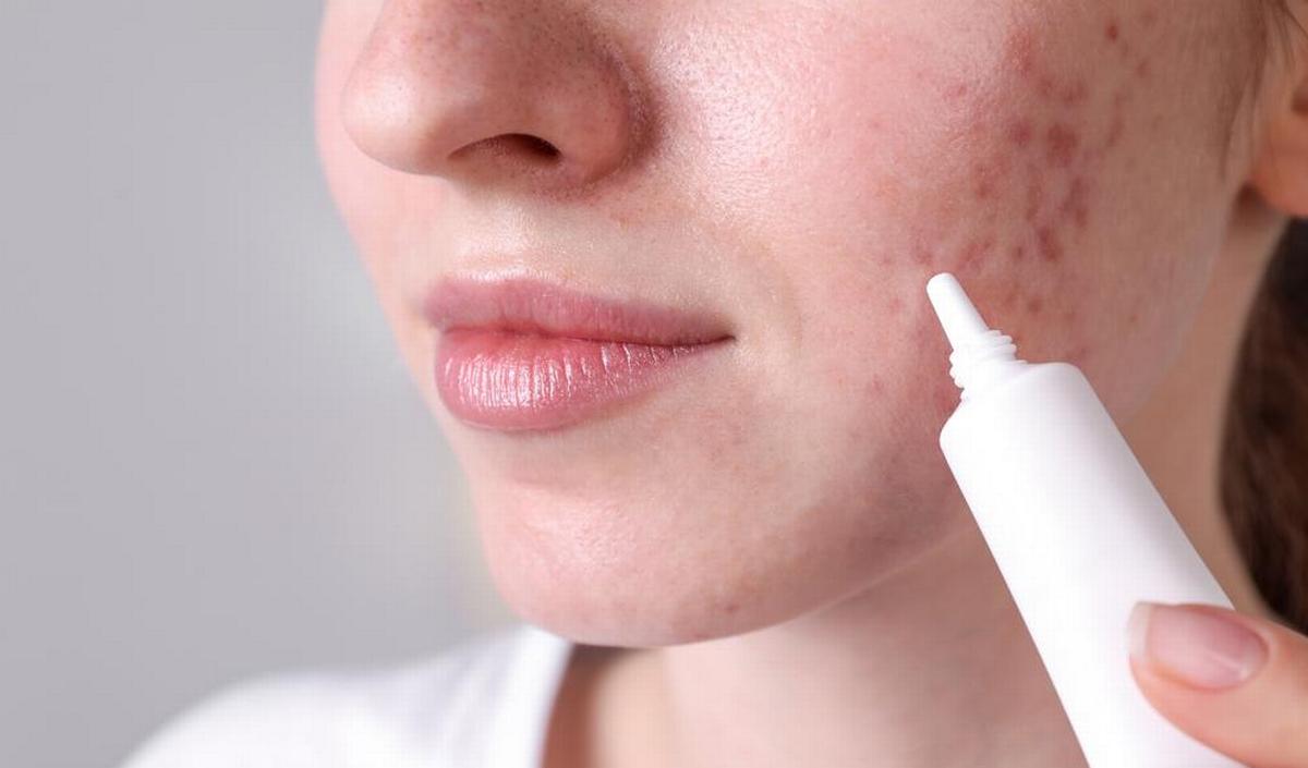 © Getty Images Getty_acne_winlevi_2025.jpg