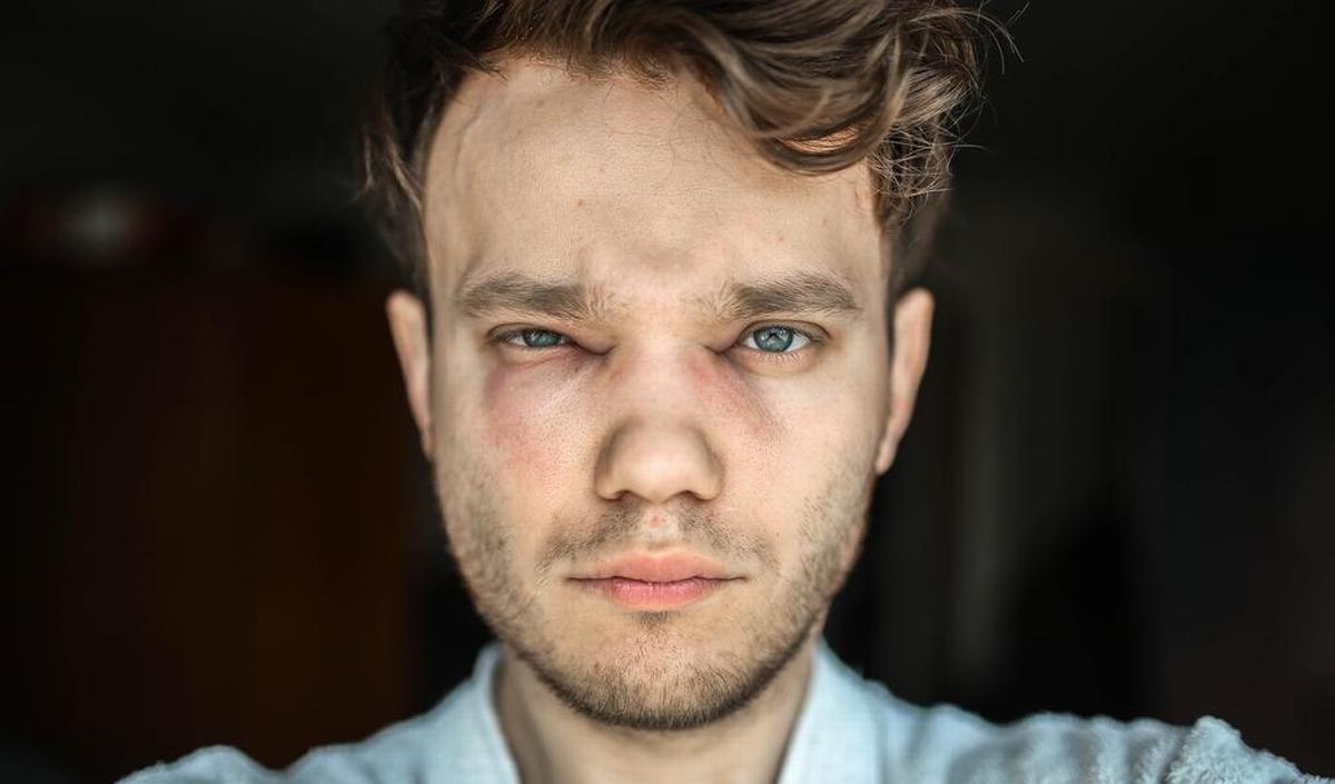 Getty_angiooedeem_zwelling_2025.jpg
