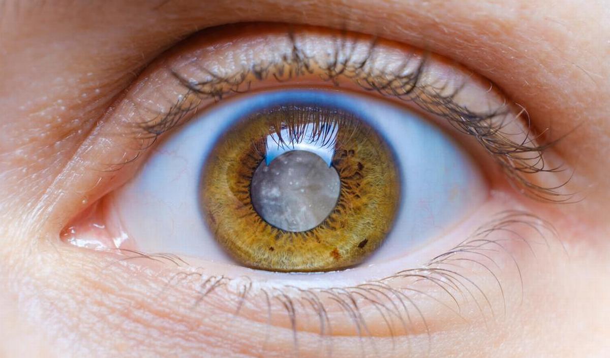 © Getty Images - En cas de cataracte, le cristallin perd progressivement sa transparence et devient opaque. Getty_cataracte_cataract_2025.jpg