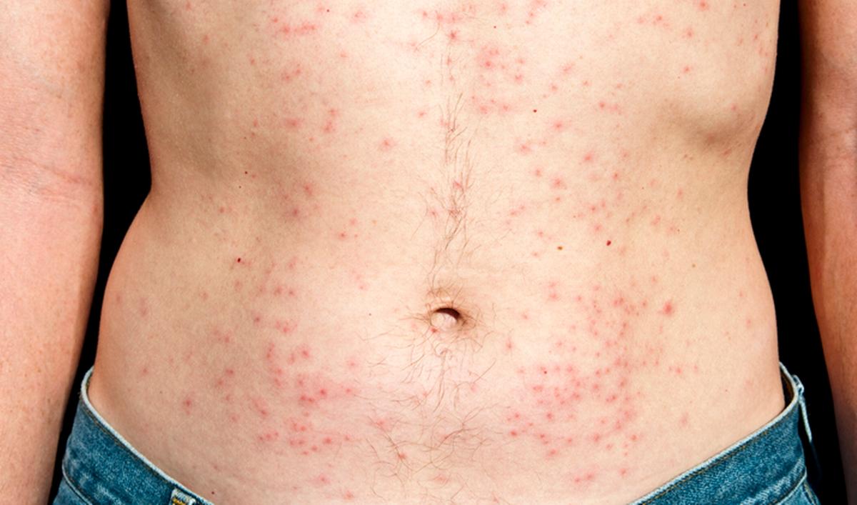 © Getty Images - les boutons de la dermatite du spa ressemblent à des boutons d'acné et peuvent contenir du pus Getty_dermatite_spa_folliculitis_2025.jpg