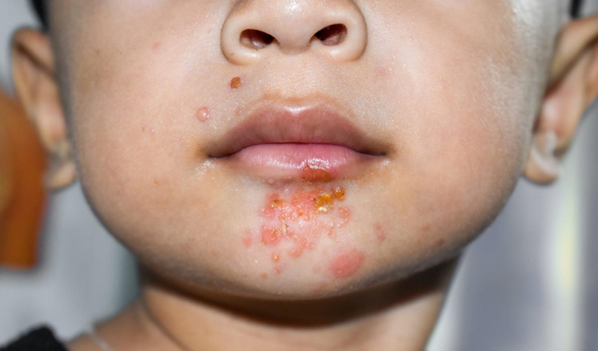 Getty_impetigo_2026.jpg