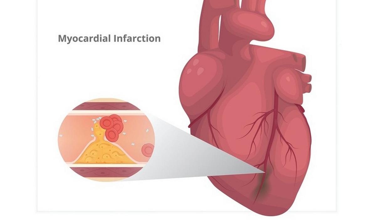 Getty_infarctus_myocarde_hartinfarct_20261.jpg