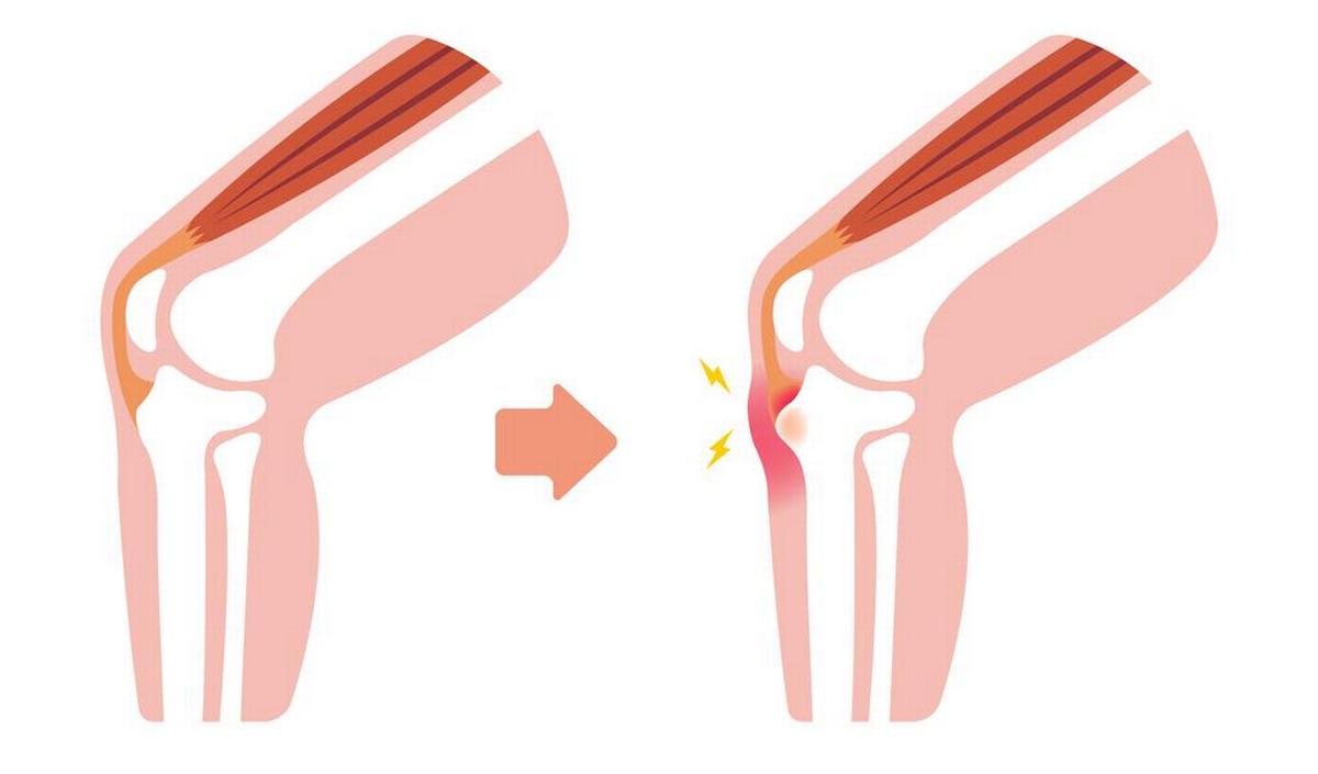 Getty_kniepijn_osgoodschlatter_2025.jpg