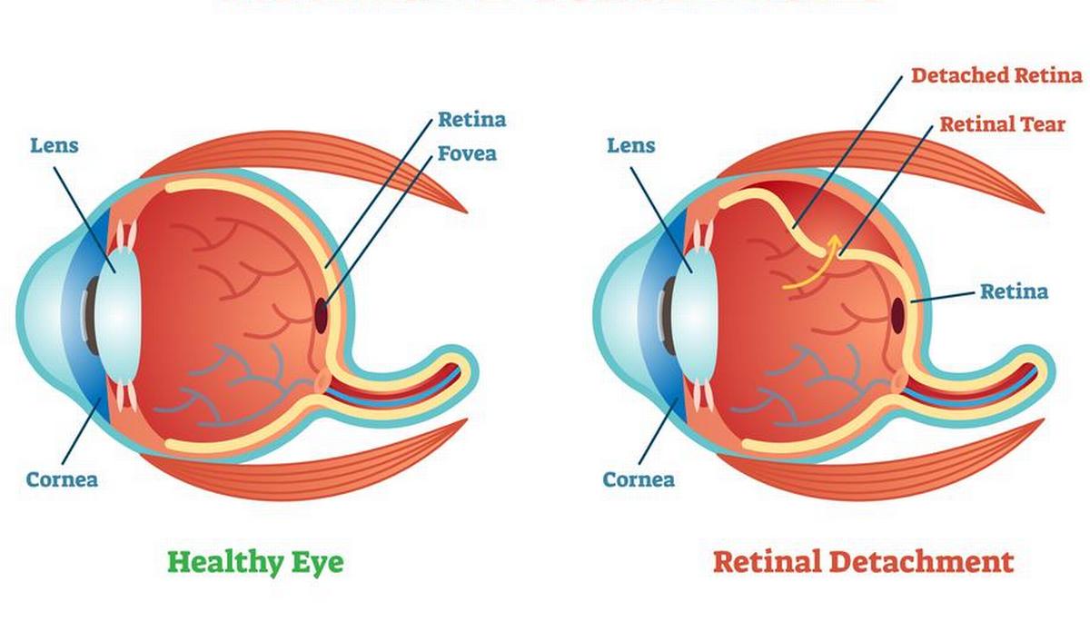 Getty_netvliesloslating_retinal_2026.jpg
