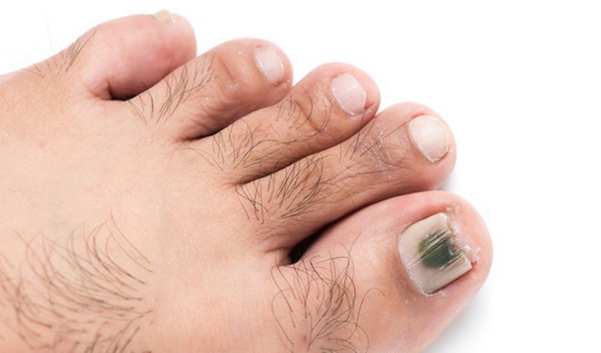 © Getty Images - Syndrome des ongles verts Getty_ongle_vert_groene_nagel_2025.jpg