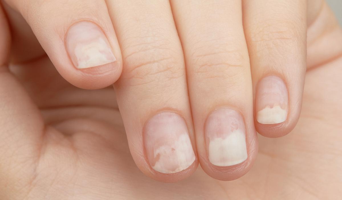 Getty_ongles_nagels_onycholysis_2026.jpg