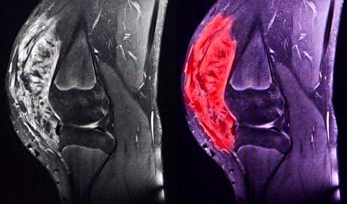 Cancer Quels Sont Les Sympt mes D un Sarcome PassionSant be Cancer Quels Sont Les Sympt mes D un Sarcome PassionSant be
