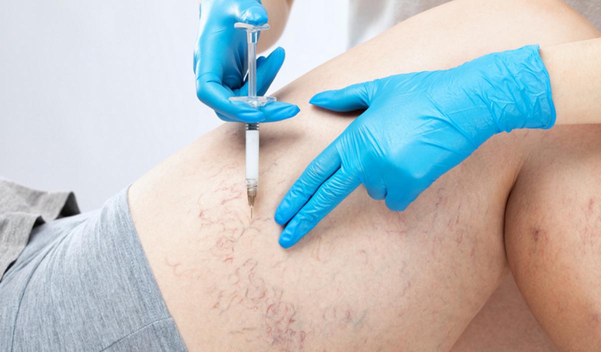 Getty_sclerotherapie_2025.jpg