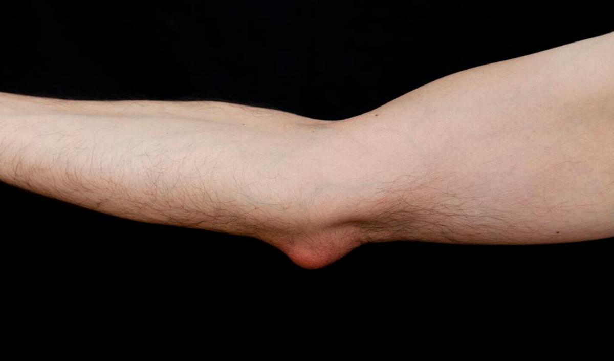 © Getty Images / slijmbeursontsteking (bursitis) van de elleboog Getty_slijmbeursontsteking_elleboog_2025.jpg