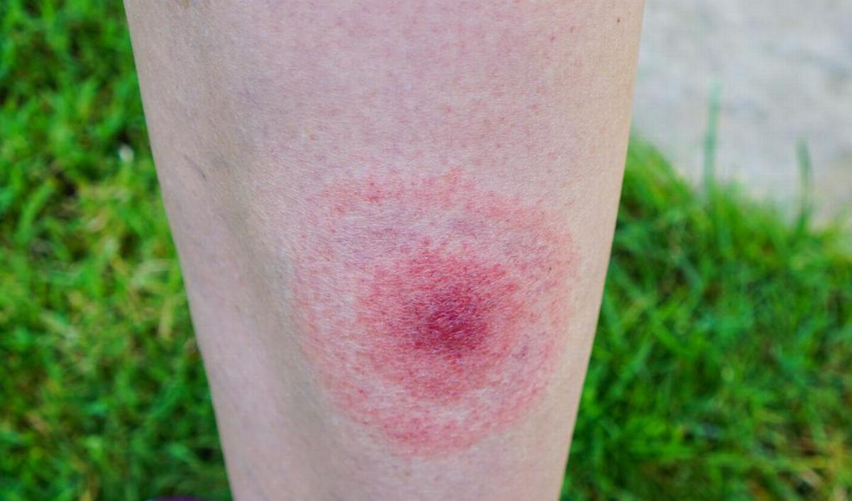 Getty_tekenbeet_lyme_2025.jpg