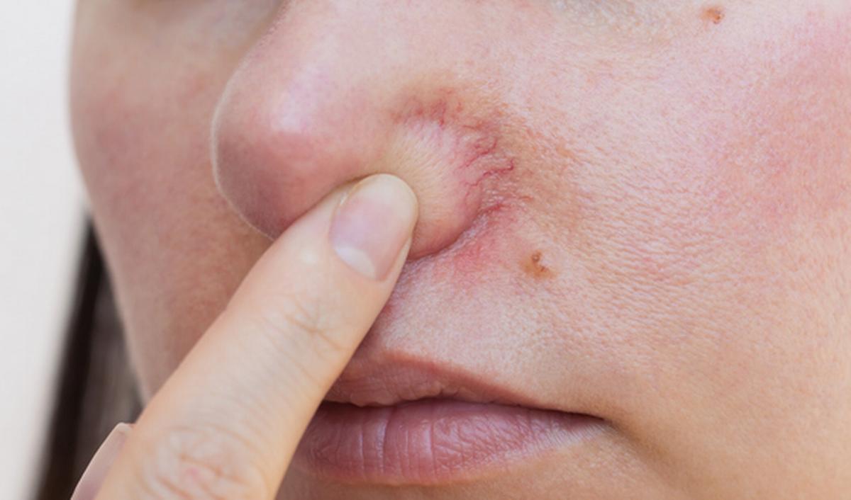 Getty_telangiectasia_spatader_2026.jpg