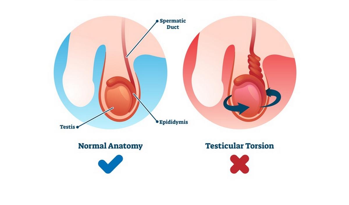 Getty_torsion_testiculaire_teelbaltorsie_20261.jpg