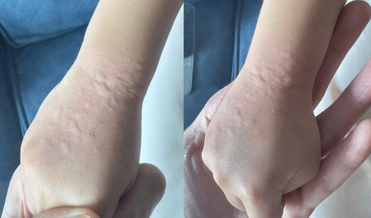 Getty_urticaria_hand_urticaire_2025.jpg