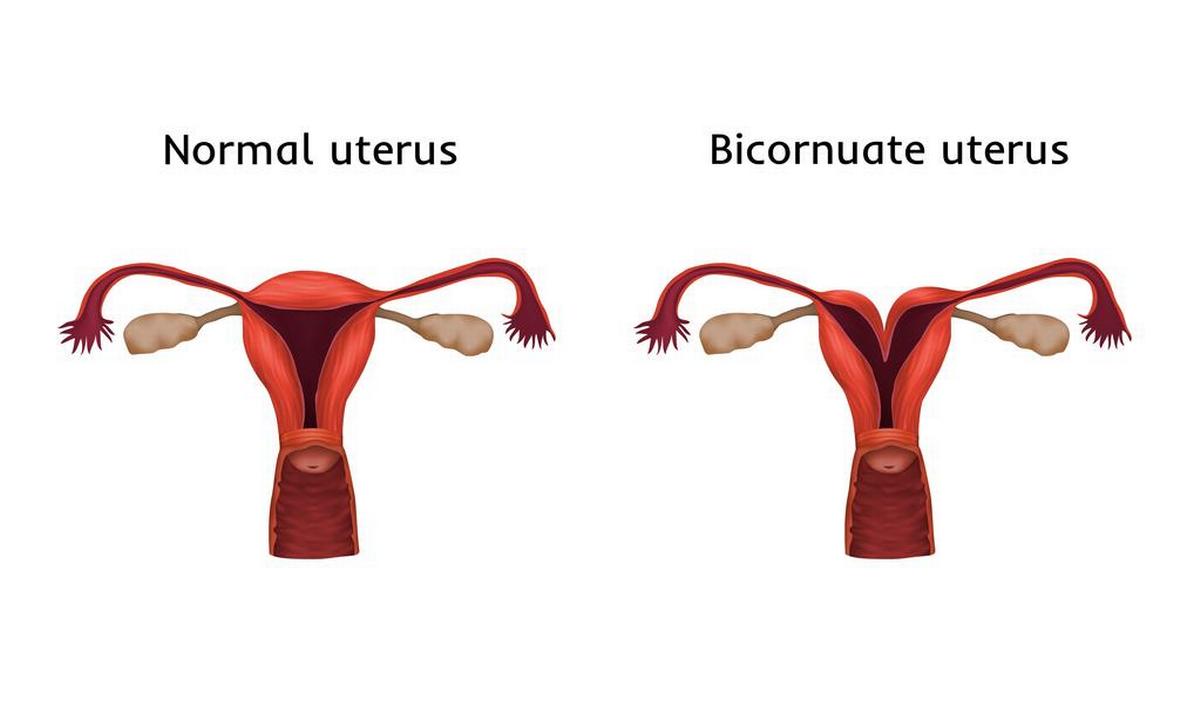 Getty_uterus_bicornis_2024.jpg