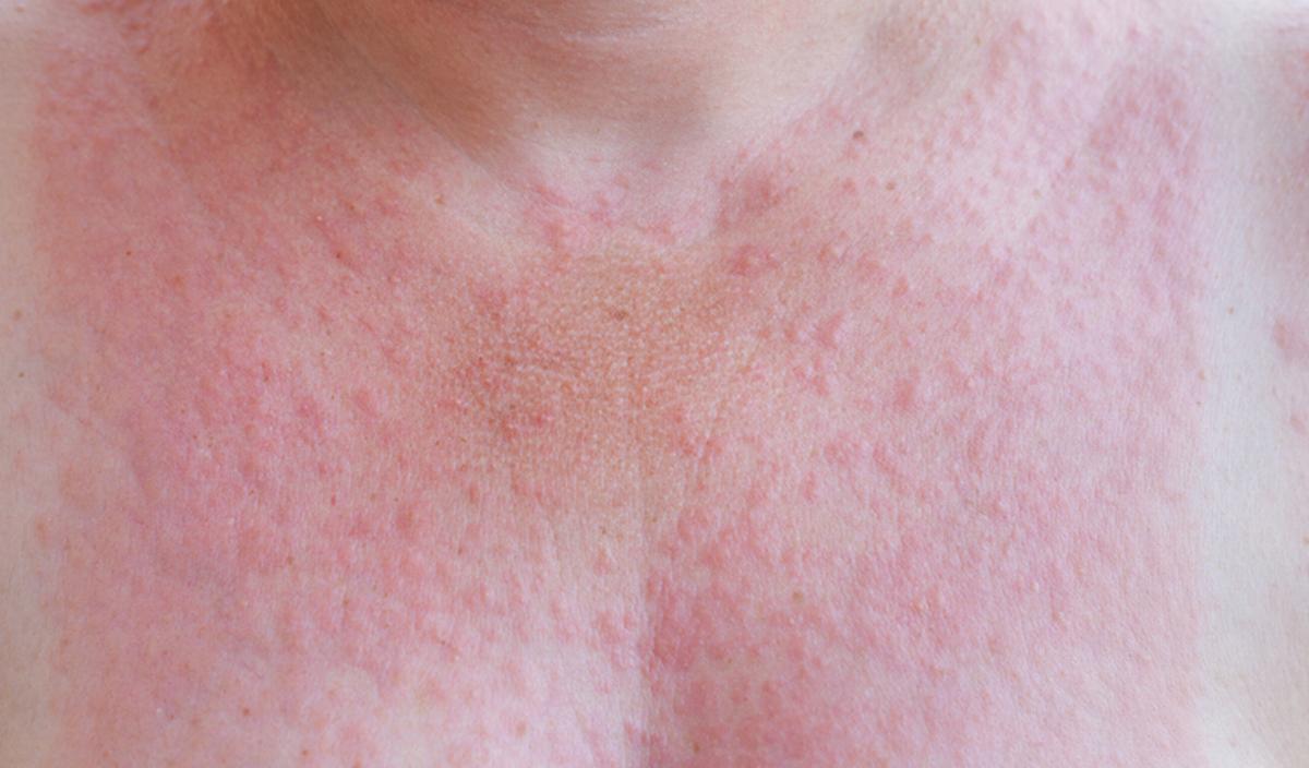 © Getty Images - Allergie au soleil, lucite Getty_zon_allergie_soleil_2025.jpg