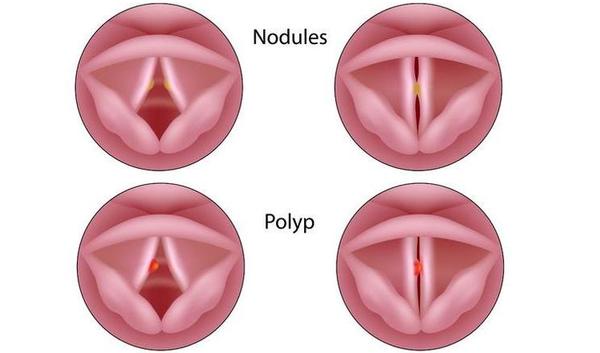 t-123-stembandnodules-poliep-hees-05-18.jpg